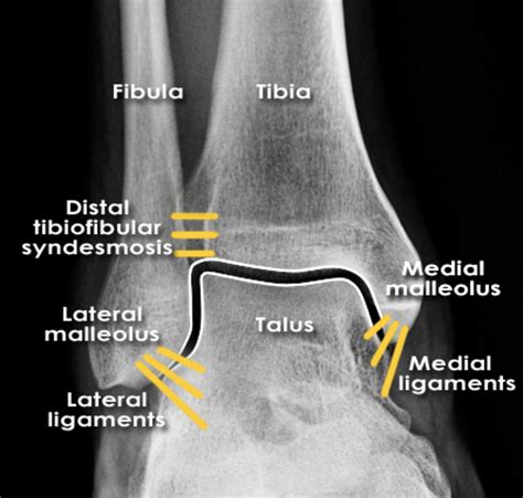 ankle lateral ligament tear test|lateral x ray ankle ligaments.